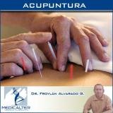 Acupuntura