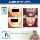 Ozonoterapia